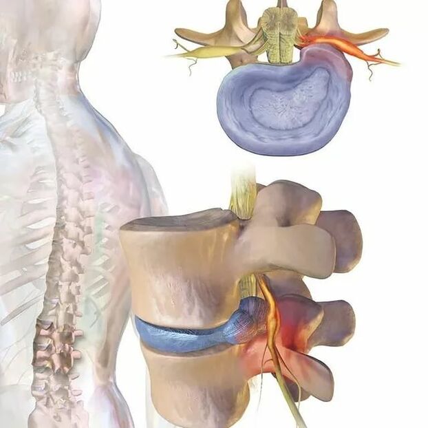 intervertebral disk problemləri