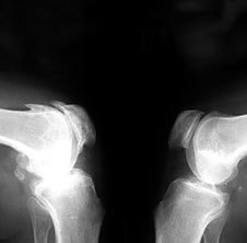 Osteoarthritis azn rentgen