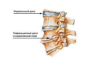 Əlamətləri boyun perniciosiores discus morbo