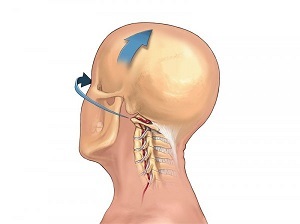 servikal bel osteokondrozunun özünü necə göstərdiyi