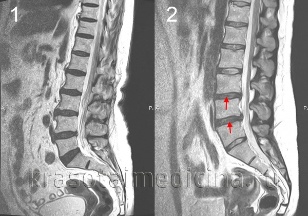 osteochondrosis bel