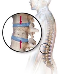 Osteoporoz bel bölgəsində bel ağrısına səbəb olur